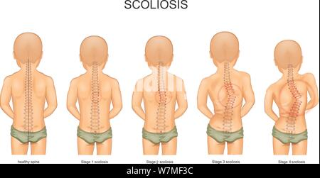 Vector illustration de l'étape de la scoliose chez l'enfant Illustration de Vecteur