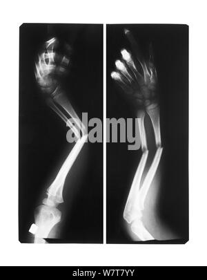 Film x-ray avant-bras AP : montrer l'arbre double fracture de l'os d'ulnarorforearm Banque D'Images