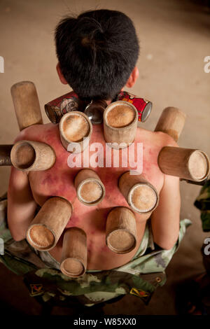 --FILE--un Chinois reçoit cupping therapy en vieille ville Daxu, ville de Guilin, Chine du Sud, région autonome Zhuang du Guangxi, 5 mai 2012. Ces sombres Banque D'Images