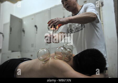 --FILE--un Chinois reçoit cupping therapy dans un bain public public à Beijing, Chine, 17 septembre 2014. Ces sombres taches rouges parsemant les Olympiens. Banque D'Images