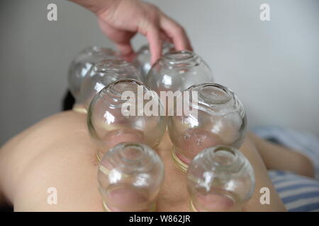 --FILE--un Chinois reçoit cupping therapy de la médecine traditionnelle chinoise (TCM) hôpital de Zunyi city, au sud-ouest de la province du Guizhou, en Chine, 9 J Banque D'Images