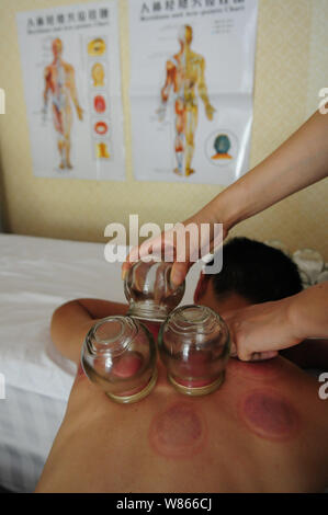 --FILE--un Chinois reçoit cupping therapy de la médecine traditionnelle chinoise (TCM) hôpital de Linyi City, Shandong province de Chine orientale, 18 Banque D'Images