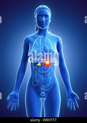 Les glandes surrénales, illustration de l'ordinateur du cancer. Banque D'Images