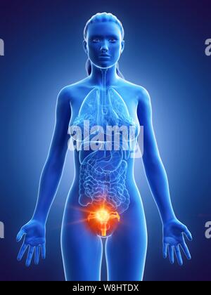 Cancer de l'utérus, ordinateur conceptuel illustration. Banque D'Images