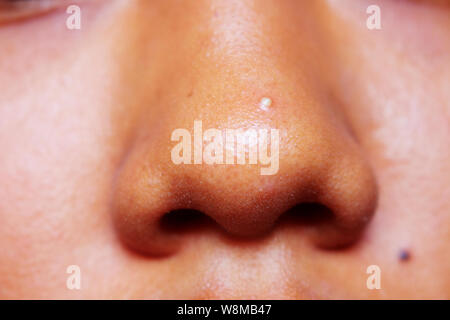 Close Up petit bouton sur le nez de la peau brune fille. Asian Girl's bouton sur le nez. Banque D'Images