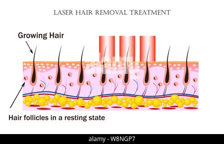 Traitement d'enlèvement de cheveux de laser. Procédure à l'origine de dommages à la follicule de cheveux sans nuire à la peau et les cheveux de tissus folicles dans l'état de repos. Illustration de Vecteur