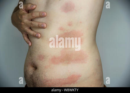 L'éruption de peau rouge l'homme à sa partie du corps - les gens avec des allergies cutanées problem concept Banque D'Images