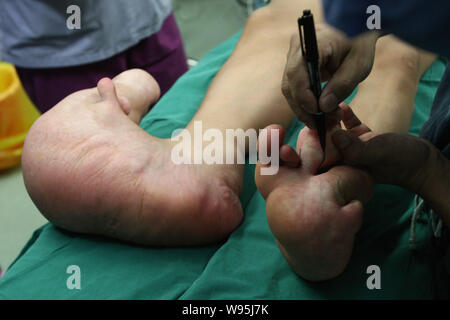 Un médecin marque le grands pieds du jeune garçon chinois Xiao hommes avant une chirurgie dans une salle d'opération à l'Hôpital pour enfants de Shanghai à Shanghai, Chi Banque D'Images