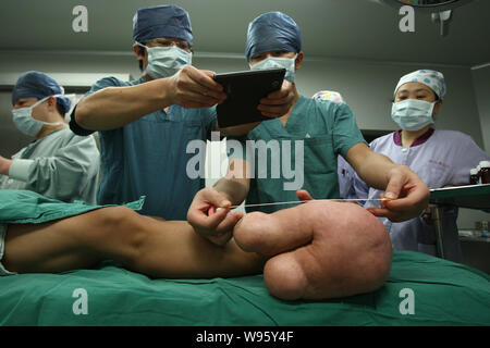 Les médecins de mesurer et de prendre des photos de la grands pieds du jeune garçon chinois Xiao hommes avant une chirurgie dans une salle d'opération à l'Hôpital pour enfants de Shang Banque D'Images