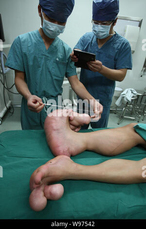 Les médecins de mesurer et de prendre des photos de la grands pieds du jeune garçon chinois Xiao hommes avant une chirurgie dans une salle d'opération à l'Hôpital pour enfants de Shang Banque D'Images