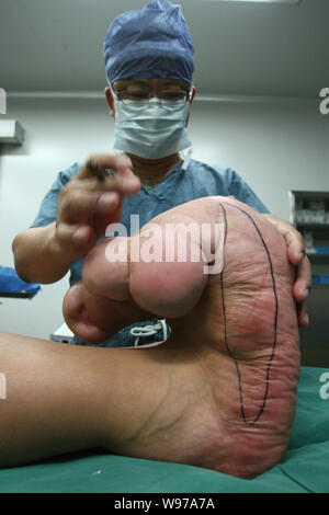 Un médecin marque le grands pieds du jeune garçon chinois Xiao hommes avant une chirurgie dans une salle d'opération à l'Hôpital pour enfants de Shanghai à Shanghai, Chi Banque D'Images