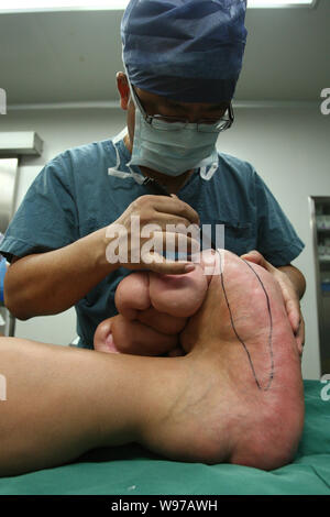 Un médecin marque le grands pieds du jeune garçon chinois Xiao hommes avant une chirurgie dans une salle d'opération à l'Hôpital pour enfants de Shanghai à Shanghai, Chi Banque D'Images