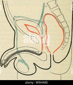 Image d'Archive de la page 1367 du Cunningham's Text-book d'anatomie (1914). Cunningham's Text-book d'anatomie cunninghamstextb00cunn Année : 1914 ( les conduits. Fig. 1045.-l'Urino-Passages génital au stade indifférencié du développement. L'uretère, solide vert contour. Wolff, vert pointillés. L'origine de la vesicula seminalis est indiqué. Miillerian conduits, orange. Du rectum, de la vessie, et urino-canal génital, rouge. Les conduits générative.-comme cela a été déjà indiqué, le mâles résultent de la Wolff, et la femelle de l'Miillerian conduits de l'embryon. Les deux sexes à première po Banque D'Images