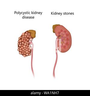 Maladie polykystique, comparaison avec les calculs rénaux, l'illustration. Banque D'Images