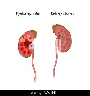 Pyélonéphrite, comparaison avec les calculs rénaux, l'illustration. Le rein gauche est enflammée à cause d'une infection. Le rein à droit a des pierres de rein (jaune). Banque D'Images