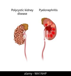 La maladie polykystique des reins, la comparaison avec pyélonéphrite, illustration. Le rein à la droite est l'inflammation due à une infection. Banque D'Images