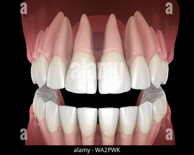 De la morphologie des maxillaires et mandibulaires et des dents gencives. Dent précise médicalement 3D illustration Banque D'Images