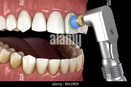 Procédure de polissage des dents avec brosse professionnelle et gel. Illustration 3D précis médicalement Banque D'Images