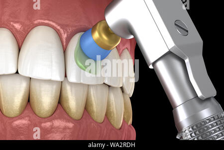 Procédure de polissage des dents avec brosse professionnelle et gel. Illustration 3D précis médicalement Banque D'Images