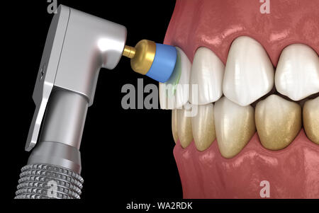 Procédure de polissage des dents avec brosse professionnelle et gel. Illustration 3D précis médicalement Banque D'Images