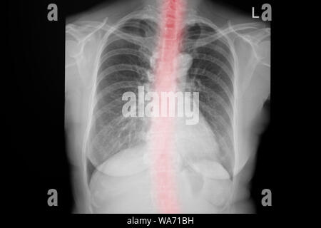 Radiographie de la image. X-Ray Image de la poitrine pour un diagnostic médical. Banque D'Images