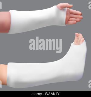 Bras et jambe plâtrée. Traitement d'une fracture de la jambe et bras cassé. La médecine et la santé. Objet réaliste isolés. Vector Illustration de Vecteur
