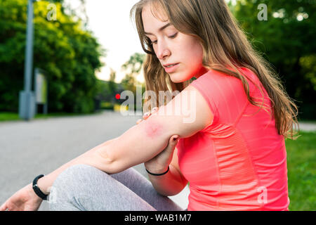 Jeune femme avec sting insectes sur son bras Banque D'Images