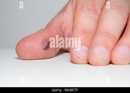 Blister de sang sous la peau du pouce. Portrait jeune homme doigt sur fond blanc Banque D'Images