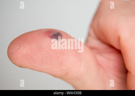 Blister de sang sous la peau du pouce. Portrait jeune homme doigt sur fond blanc Banque D'Images