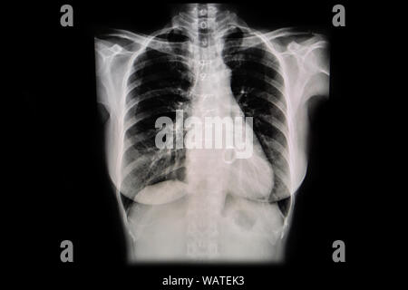 Définir la radiographie film pris d'examiner le coeur. Concept de la santé. Banque D'Images