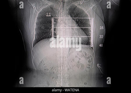 Définir la radiographie film pris d'examiner le coeur. Concept de la santé. Banque D'Images