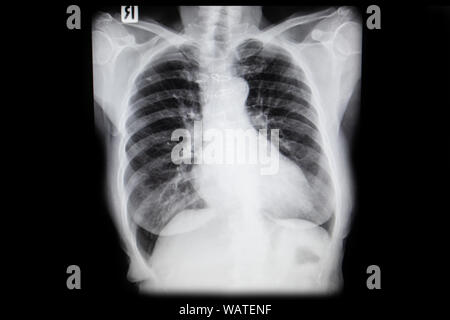 Définir la radiographie film pris d'examiner le coeur. Concept de la santé. Banque D'Images