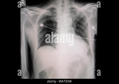 Définir la radiographie film pris d'examiner le coeur. Concept de la santé. Banque D'Images