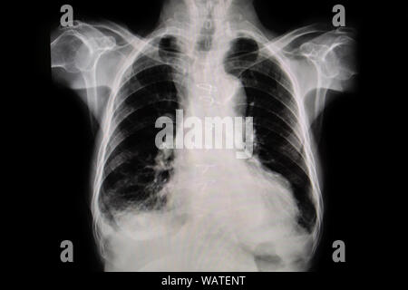 Définir la radiographie film pris d'examiner le coeur. Concept de la santé. Banque D'Images