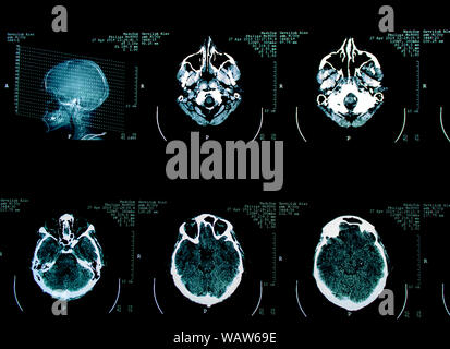 examen tomographique d'une tête humaine Banque D'Images