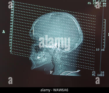 examen tomographique d'une tête humaine Banque D'Images