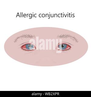 La conjonctivite allergique, l'illustration. Banque D'Images