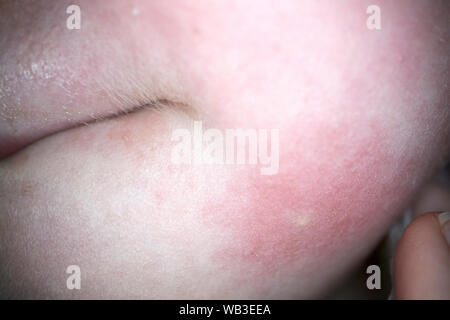 Piqûre de guêpe mark et l'inflammation sur le visage d'une petite fille de cinq ans, England, UK Banque D'Images