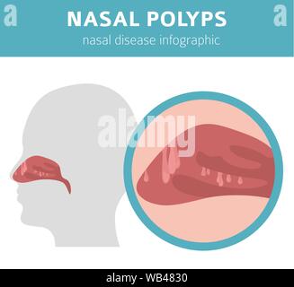 Maladies du nez. Polypes nasaux les causes, le diagnostic et le traitement de la conception infographique médical. Vector illustration Illustration de Vecteur