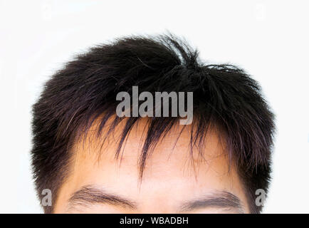 La perte de cheveux, tête d'homme avec la perte de cheveux avant les symptômes Banque D'Images