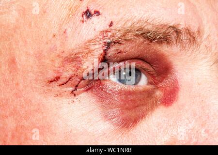 Homme avec un grand œil bleu violet. Chien mordant sur le visage. Blessure à l'œil. Gros hématomes sur l'œil masculin. Le traitement de blessures. Oeil Boxer. Banque D'Images