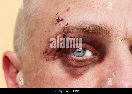 Homme avec un grand œil bleu violet. Chien mordant sur le visage. Blessure à l'œil. Gros hématomes sur l'œil masculin. Le traitement de blessures. Oeil Boxer. Banque D'Images