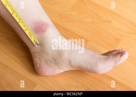 Une seule grande morsure de cheval sur la jambe gauche au-dessus de la cheville avec du ruban de mesure jaune Banque D'Images