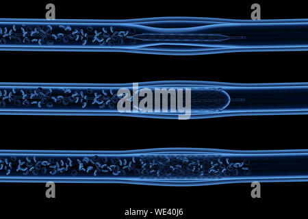 Le rendu 3d x-ray une angioplastie par ballonnet intérieur avec endoprothèse d'idées Banque D'Images
