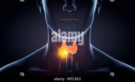 3D illustration médicale cancer de la thyroïde d'un homme, médicalement illustration sur fond noir Banque D'Images