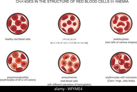 Vector illustration de la structure des globules rouges dans les anémies diverses Illustration de Vecteur