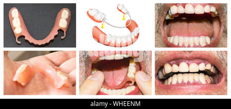 Avec la réhabilitation dentaire prothèse supérieure et inférieure, avant et après le traitement Banque D'Images