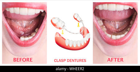 Avec la réhabilitation dentaire prothèse supérieure et inférieure, avant et après le traitement Banque D'Images