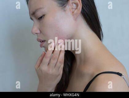 Souligné femme sortir avec l'acné sur le visage. Banque D'Images