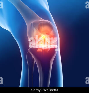 Médicalement précis 3D illustration montrant l'articulation du genou douloureux avec mis en évidence du ligament croisé antérieur et postérieur, ménisque, cartilage articulaire Banque D'Images